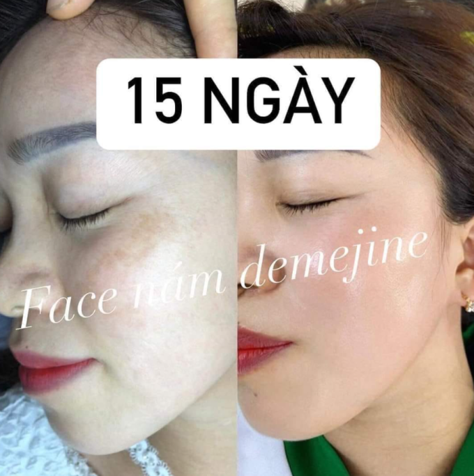 Combo Kem Demejine Hàn Quốc Ngày & Đêm – Hàng Chính Hãng – Mờ Nám, Tàn Nhang