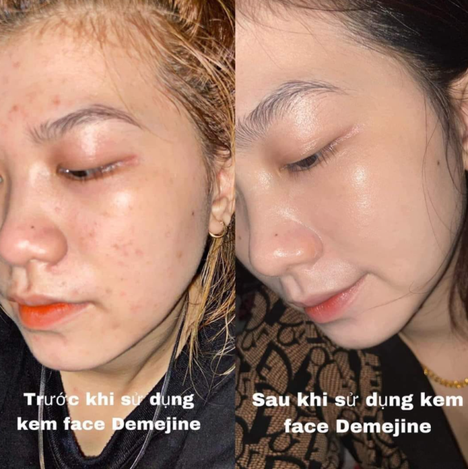 Combo Kem Demejine Hàn Quốc Ngày & Đêm – Hàng Chính Hãng – Mờ Nám, Tàn Nhang