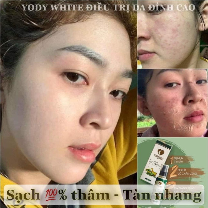 Serum Tái Tạo Da Yody White Phương Anh – Tái Tạo Da Hiệu Quả