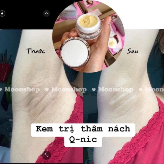 Kem Thâm Nách Qnic Tím – Mờ Thâm Nhanh, Hiệu Quả